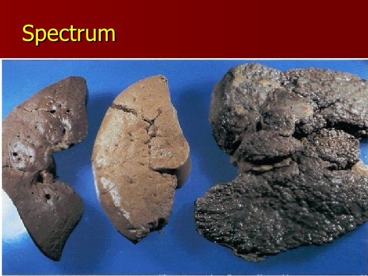 Enlarged Liver In Non Drinker Enlarged Liver In Non Drinker