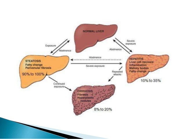 Alcoholic liver disease