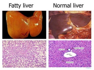 Fatty liver Normal liver
 