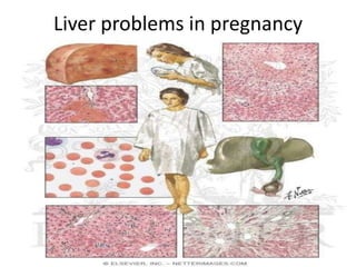 Liver problems in pregnancy
 