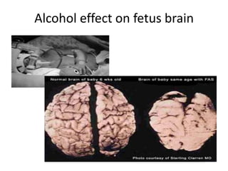 Alcohol effect on fetus brain
 