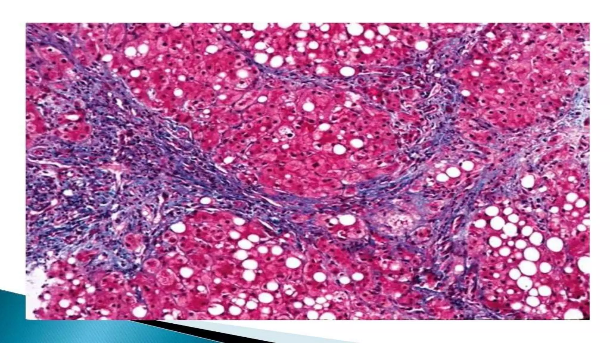 Alcoholic liver disease