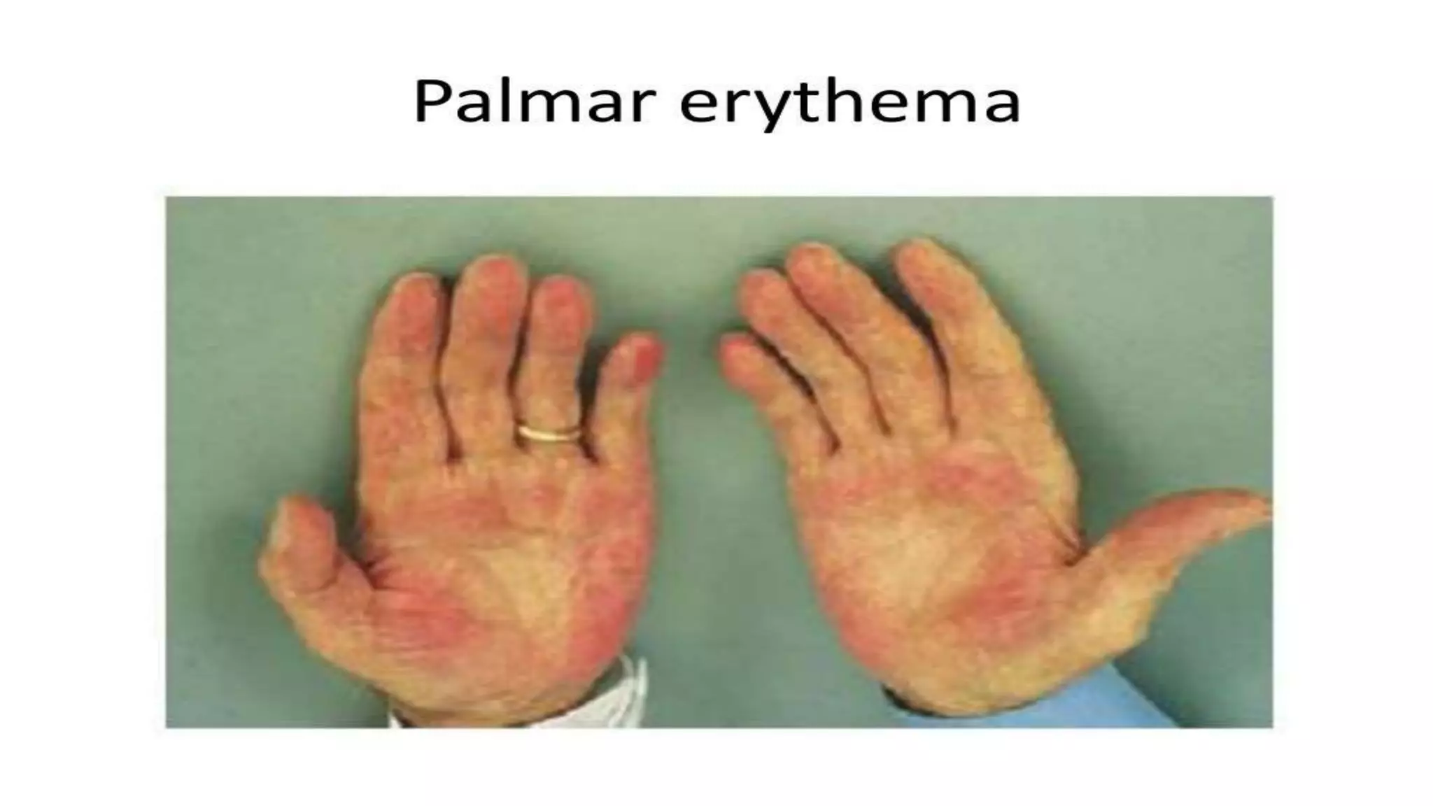 Alcoholic liver disease