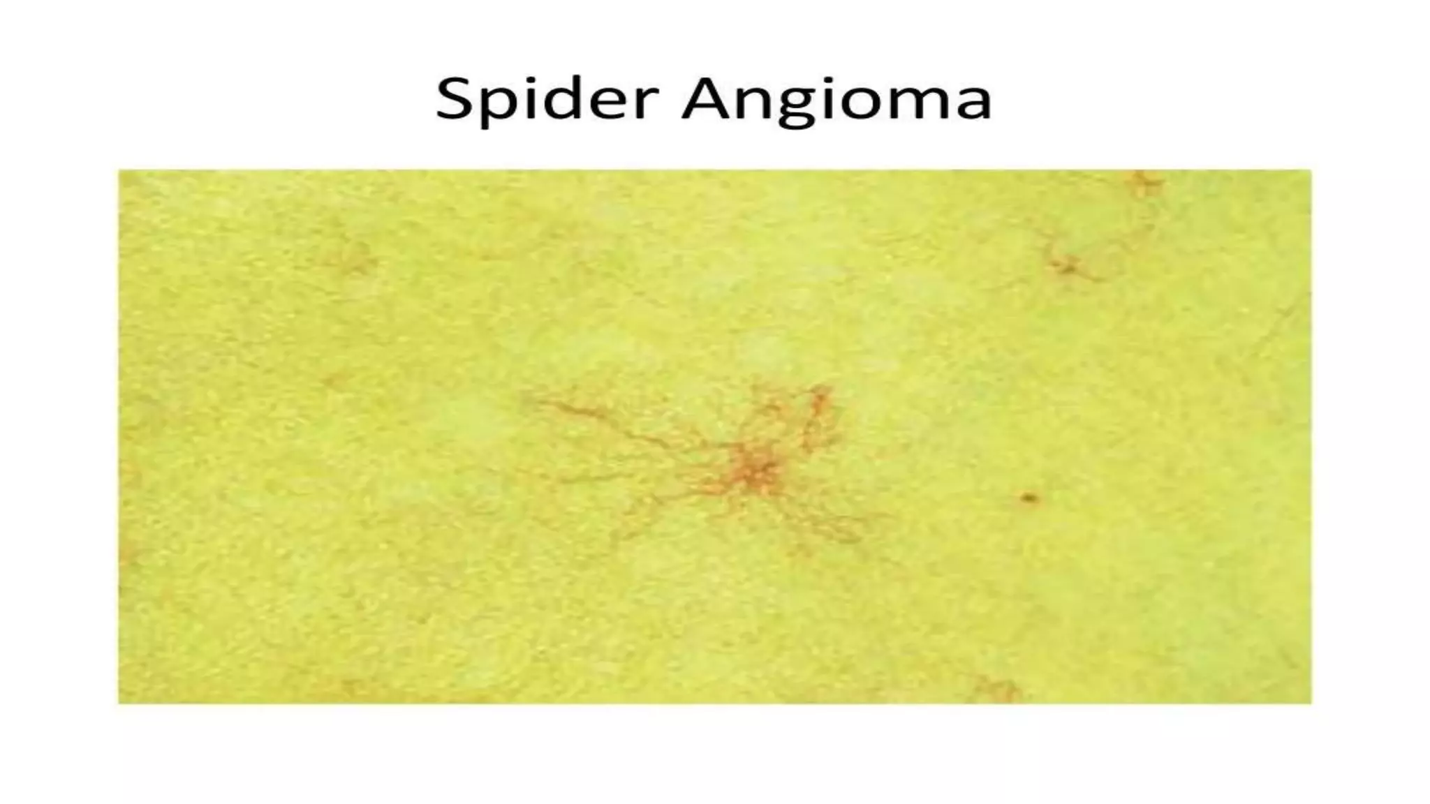 Alcoholic liver disease