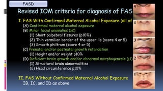 Revised IOM criteria for diagnosis of FASD (I)
I. FAS With Confirmed Maternal Alcohol Exposure (all of A–D)
(A) Confirmed maternal alcohol exposure
(B) Minor facial anomalies (≥2)
(1) Short palpebral fissures (p10%)
(2) Thin vermilion border of the upper lip (score 4 or 5)
(3) Smooth philtrum (score 4 or 5)
(C) Prenatal and/or postnatal growth retardation
(1) Height and/or weight p10%
(D) Deficient brain growth and/or abnormal morphogenesis (≥1)
(1) Structural brain abnormalities
(2) Head circumference p10%
II. FAS Without Confirmed Maternal Alcohol Exposure
IB, IC, and ID as above
FASD
 