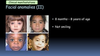 Facial anomalies (II)
 8 months – 8 years of age
 Not smiling
Clinical manifestations
 