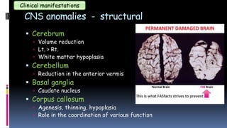 CNS anomalies - structural
 Cerebrum
 Volume reduction
 Lt. > Rt.
 White matter hypoplasia
 Cerebellum
 Reduction in the anterior vermis
 Basal ganglia
 Caudate nucleus
 Corpus callosum
 Agenesis, thinning, hypoplasia
 Role in the coordination of various function
Clinical manifestations
 