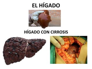 EL HÍGADO 
HÍGADO CON CIRROSIS 
 