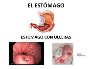 EL ESTÓMAGO 
ESTÓMAGO CON ULCERAS 
 