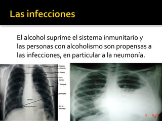 El alcohol suprime el sistema inmunitario y
las personas con alcoholismo son propensas a
las infecciones, en particular a la neumonía.
 