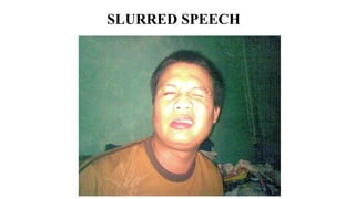 SLURRED SPEECH
