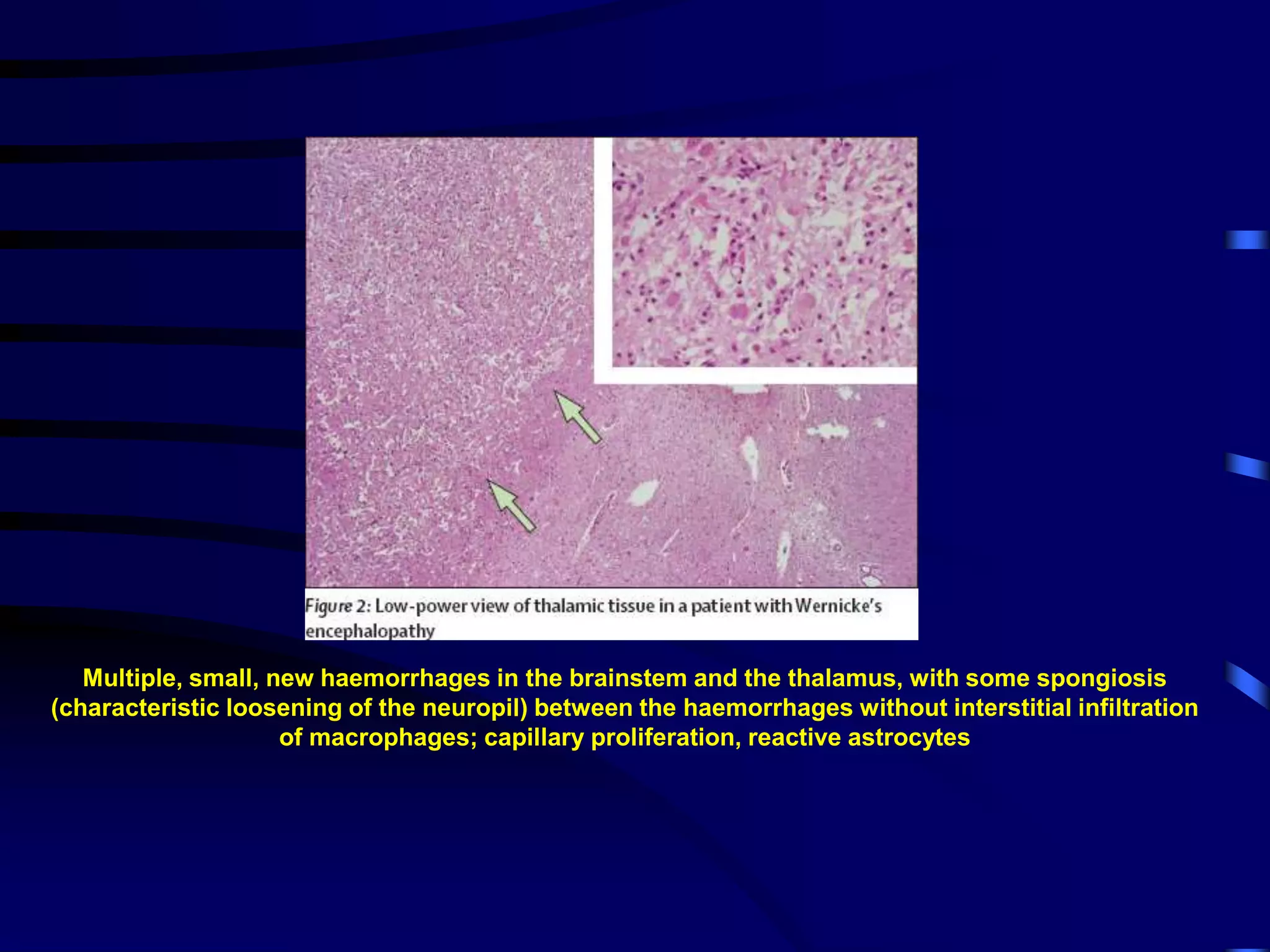 Multiple, small, new haemorrhages in the brainstem and the thalamus, with some spongiosis
(characteristic loosening of the neuropil) between the haemorrhages without interstitial infiltration
of macrophages; capillary proliferation, reactive astrocytes
 