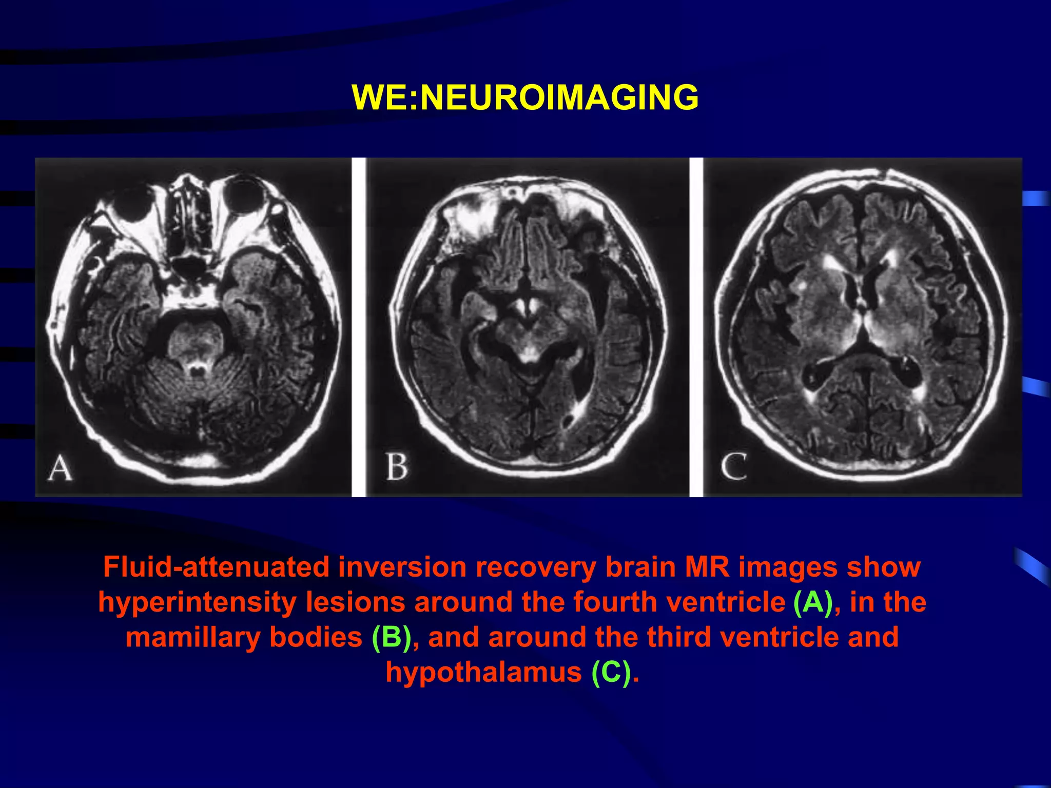 WE:NEUROIMAGING
Fluid-attenuated inversion recovery brain MR images show
hyperintensity lesions around the fourth ventricle (A), in the
mamillary bodies (B), and around the third ventricle and
hypothalamus (C).
 