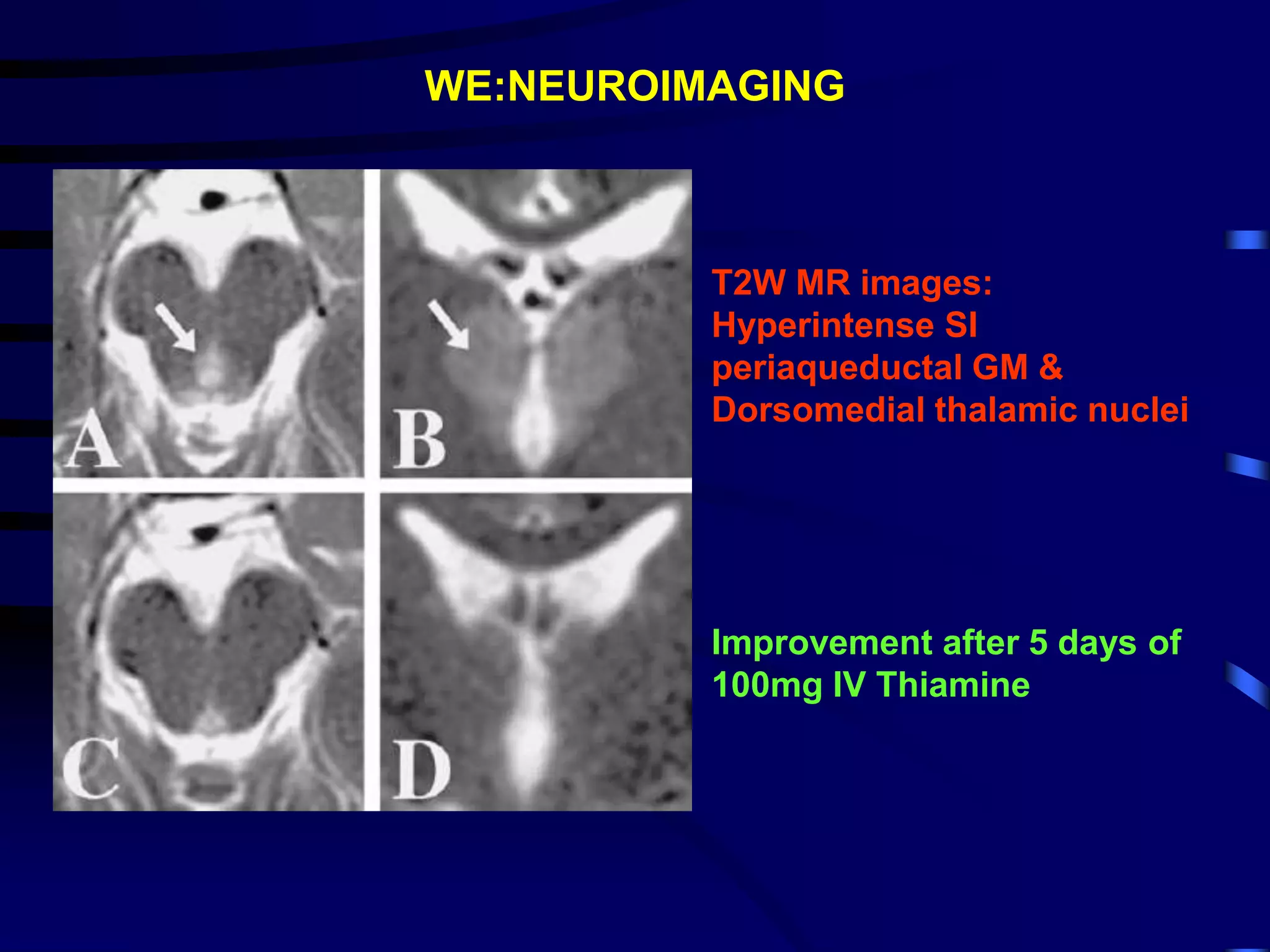 WE:NEUROIMAGING
T2W MR images:
Hyperintense SI
periaqueductal GM &
Dorsomedial thalamic nuclei
Improvement after 5 days of
100mg IV Thiamine
 