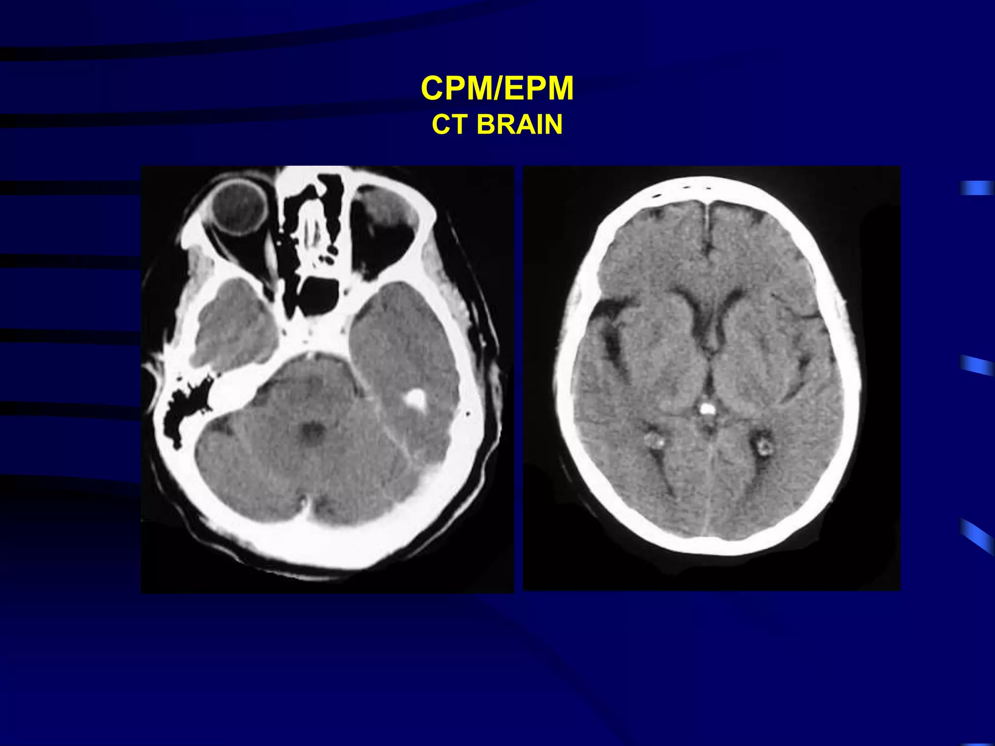 CPM/EPM
CT BRAIN
 