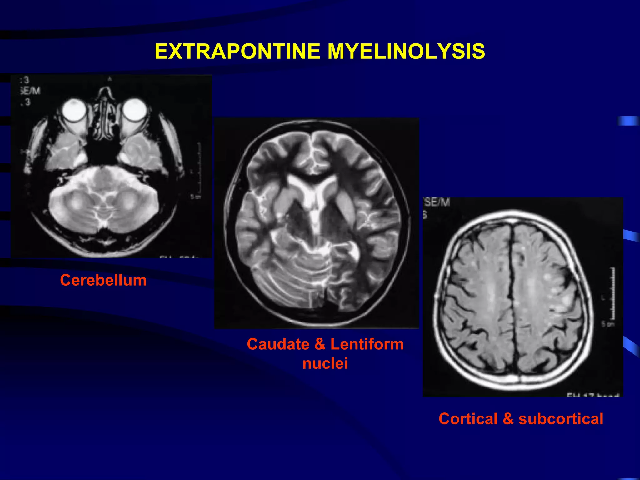 EXTRAPONTINE MYELINOLYSIS
Cerebellum
Caudate & Lentiform
nuclei
Cortical & subcortical
 