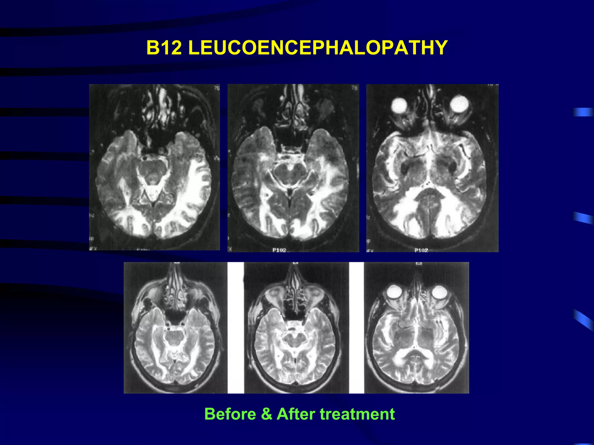 B12 LEUCOENCEPHALOPATHY
Before & After treatment
 