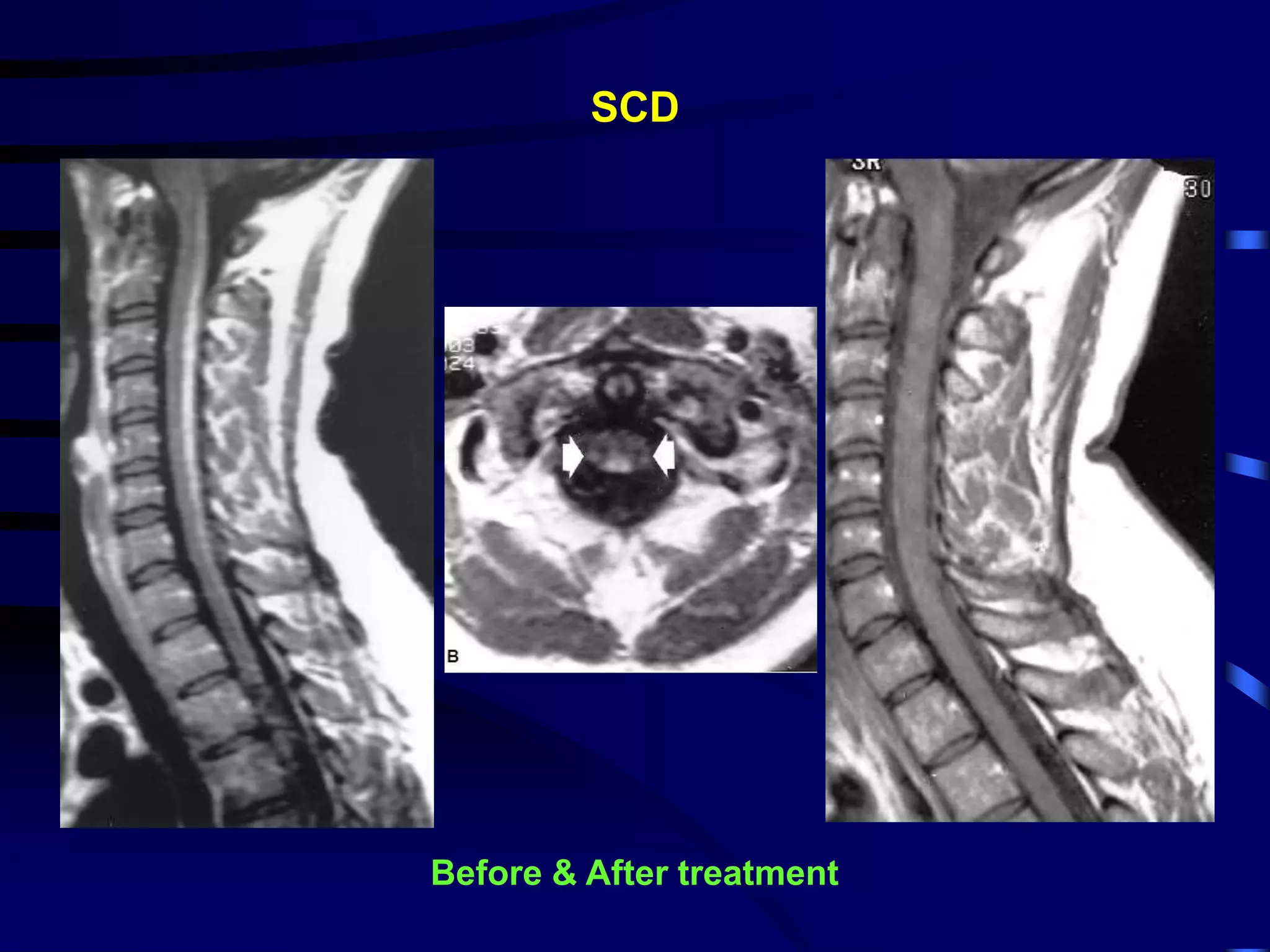 SCD
Before & After treatment
 