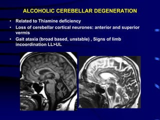 Alcohol Related Brain Damage.ppt