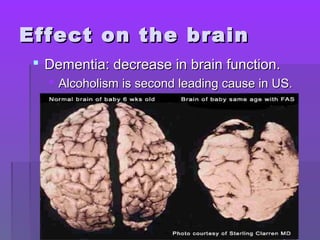 EEffffeecctt oonn tthhee bbrraaiinn 
 DDeemmeennttiiaa:: ddeeccrreeaassee iinn bbrraaiinn ffuunnccttiioonn.. 
 AAllccoohhoolliissmm iiss sseeccoonndd lleeaaddiinngg ccaauussee iinn UUSS.. 
 