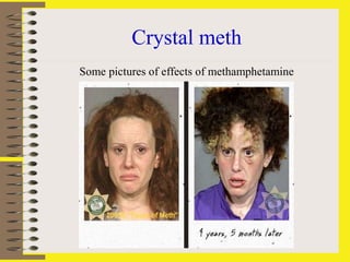 Crystal meth
Some pictures of effects of methamphetamine
 