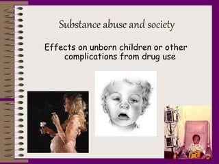 Substance abuse and society
Effects on unborn children or other
complications from drug use
 