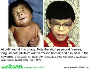 4 FAS facial phenotype for
Caucasian, Native American,
African American, and Asian
American children are shown
www.apel-pe...