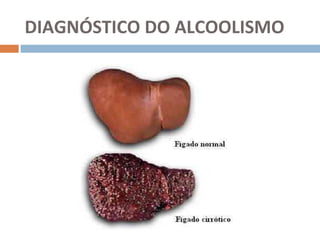 DIAGNÓSTICO DO ALCOOLISMO
 