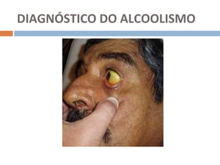 DIAGNÓSTICO DO ALCOOLISMO
 