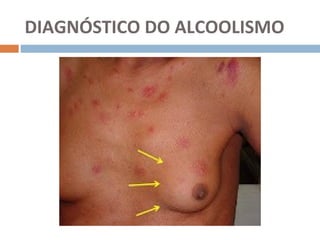 DIAGNÓSTICO DO ALCOOLISMO
 