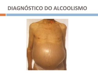 DIAGNÓSTICO DO ALCOOLISMO
 