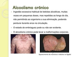  Ingestão excessiva habitual de bebidas alcoólicas, muitas
vezes em pequenas doses, mas repetidas ao longo do dia,
não permitindo ao organismo a sua eliminação, podendo
perdurar durante anos na circulação.
 O estado de embriaguez pode ou não ser evidente.
 O alcoolismo crónico pode levar a malformações corporais.
Aparecimento de manchas e nódulos no fígado
Alcoolismo crónico
 
