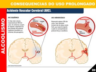 Acidente Vascular Cerebral (AVC).
ALCOOLISMO CONSEQUENCIAS DO USO PROLONGADO
20
 