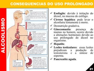  Esofagite: devido à irritação do
álcool, na mucosa do esôfago.
 Cirrose hepática: pode levar o
alcoólatra lentamente à morte.
 Desnutrição gradativa.
 Ginecomastia: presença de
mamas no homem, ocorre devido
a alterações hormonais devido ao
uso prolongado do álcool no
organismo.
 Hepatite.
 Lesões testiculares: essas lesões
prejudicam a produção de
testosterona e a síntese de
esperma.
 Pancreatite aguda.
ALCOOLISMO CONSEQUENCIAS DO USO PROLONGADO
21
 