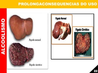 ALCOOLISMO PROLONGACONSEQUENCIAS DO USO
22
 