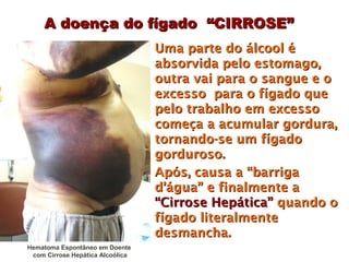 A doença do fígado “CIRROSE”
                                  Uma parte do álcool é
                                  absorvida pelo estomago,
                                  outra vai para o sangue e o
                                  excesso para o fígado que
                                  pelo trabalho em excesso
                                  começa a acumular gordura,
                                  tornando-se um fígado
                                  gorduroso.
                                  Após, causa a “barriga
                                  d’água” e finalmente a
                                  “Cirrose Hepática” quando o
                                  fígado literalmente
                                  desmancha.
Hematoma Espontâneo em Doente
 com Cirrose Hepática Alcoólica
 