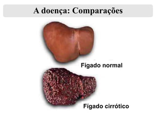 A doença: Comparações

Fígado normal

Fígado cirrótico

 