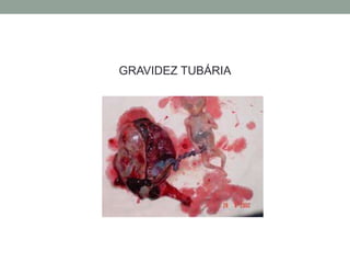 GRAVIDEZ TUBÁRIA
 