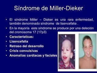 Síndrome de Miller-Dieker
• El síndrome Miller – Dieker es una rara enfermedad,
también denominado síndrome de lisencefalia .
• En la mayoría este síndrome se produce por una deleción
del cromosoma 17 (17p3)
• Características:
• Lisencefalia
• Retraso del desarrollo
• Crisis convulsivas
• Anomalías cardiacas y faciales
 