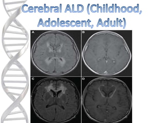 Ald (x linked adrenoleukodystrophy) | PPTX