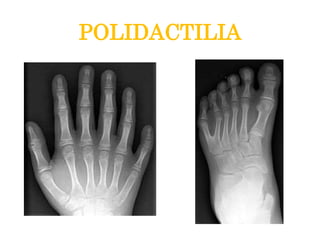 POLIDACTILIA
 