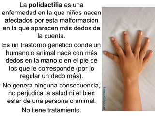 La polidactilia es una
enfermedad en la que niños nacen
afectados por esta malformación
en la que aparecen más dedos de
la cuenta.
Es un trastorno genético donde un
humano o animal nace con más
dedos en la mano o en el pie de
los que le corresponde (por lo
regular un dedo más).
No genera ninguna consecuencia,
no perjudica la salud ni el bien
estar de una persona o animal.
No tiene tratamiento.
 