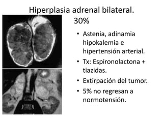 Hiperplasia adrenal bilateral.
30%
• Astenia, adinamia
hipokalemia e
hipertensión arterial.
• Tx: Espironolactona +
tiazidas.
• Extirpación del tumor.
• 5% no regresan a
normotensión.

 