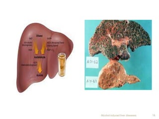 Alcohol induced liver diseases 18
 