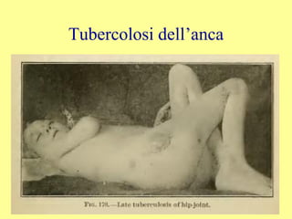 Tubercolosi dell’anca
 