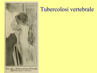 Tubercolosi vertebrale
 