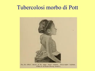 Tubercolosi morbo di Pott
 