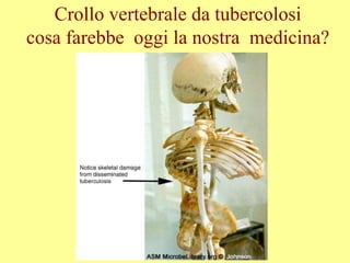 Crollo vertebrale da tubercolosi
cosa farebbe oggi la nostra medicina?
 