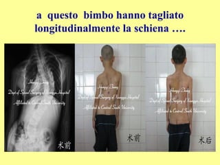 a questo bimbo hanno tagliato
longitudinalmente la schiena ….
 