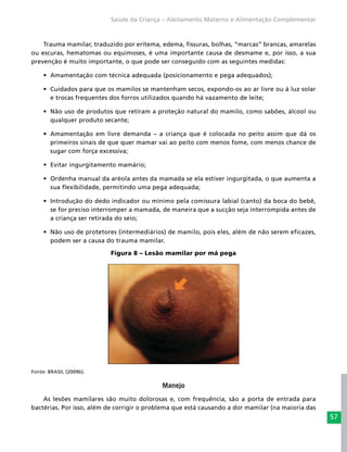 57
Saúde da Criança – Aleitamento Materno e Alimentação Complementar
Trauma mamilar, traduzido por eritema, edema, fissuras, bolhas, “marcas” brancas, amarelas
ou escuras, hematomas ou equimoses, é uma importante causa de desmame e, por isso, a sua
prevenção é muito importante, o que pode ser conseguido com as seguintes medidas:
•	 Amamentação com técnica adequada (posicionamento e pega adequados);
•	 Cuidados para que os mamilos se mantenham secos, expondo-os ao ar livre ou à luz solar
e trocas frequentes dos forros utilizados quando há vazamento de leite;
•	 Não uso de produtos que retiram a proteção natural do mamilo, como sabões, álcool ou
qualquer produto secante;
•	 Amamentação em livre demanda – a criança que é colocada no peito assim que dá os
primeiros sinais de que quer mamar vai ao peito com menos fome, com menos chance de
sugar com força excessiva;
•	 Evitar ingurgitamento mamário;
•	 Ordenha manual da aréola antes da mamada se ela estiver ingurgitada, o que aumenta a
sua flexibilidade, permitindo uma pega adequada;
•	 Introdução do dedo indicador ou mínimo pela comissura labial (canto) da boca do bebê,
se for preciso interromper a mamada, de maneira que a sucção seja interrompida antes de
a criança ser retirada do seio;
•	 Não uso de protetores (intermediários) de mamilo, pois eles, além de não serem eficazes,
podem ser a causa do trauma mamilar.
Figura 8 – Lesão mamilar por má pega
Fonte: BRASIL (2009b).
Manejo
As lesões mamilares são muito dolorosas e, com frequência, são a porta de entrada para
bactérias. Por isso, além de corrigir o problema que está causando a dor mamilar (na maioria das
 